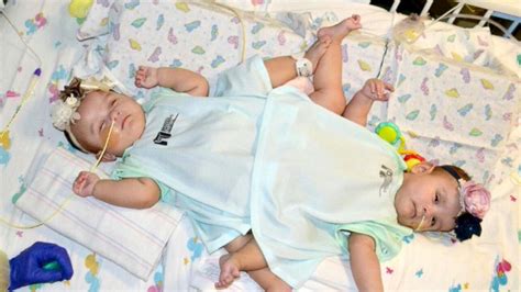 Nuha and Nuba were joined at the spine since they were in their mother's womb. Since their birth on March 21, 2022, the conjoined twins underwent six …